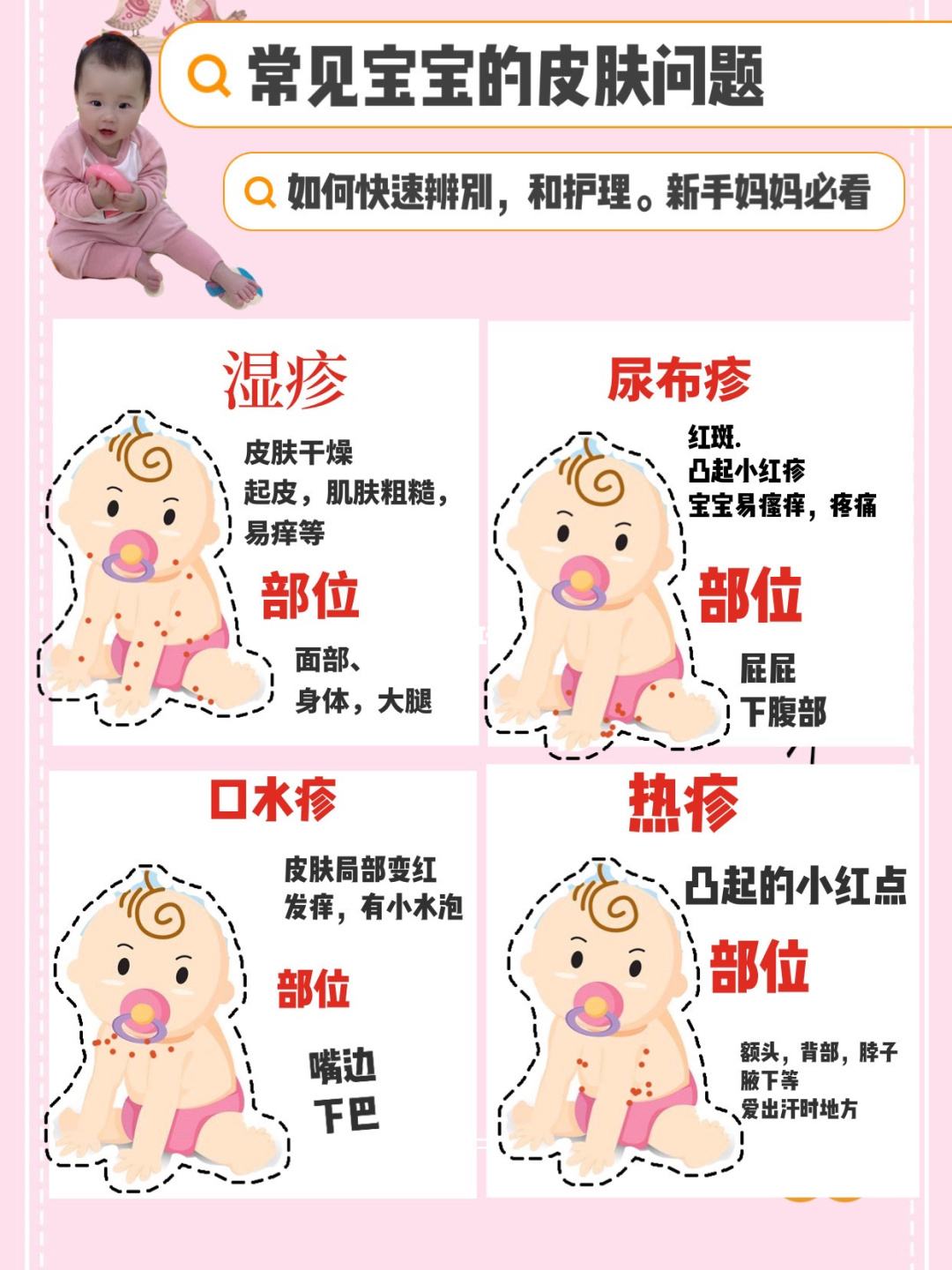 去除婴儿热疹小妙招-湿疹为什么要大量擦润肤乳